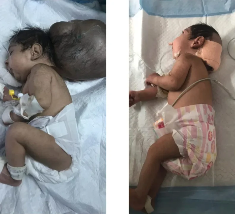 Enterré vivant par son père, un bébé à deux têtes est sauvé deux fois