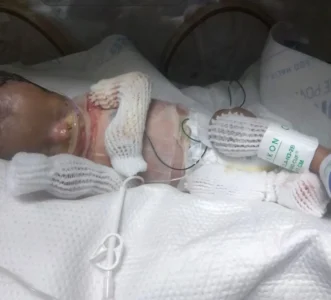 Ja'bari Gray, le bébé sans peau