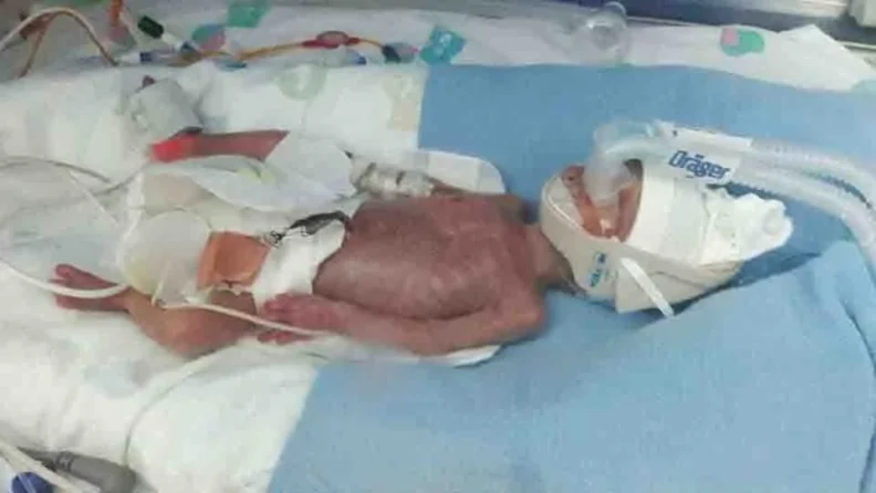 Photo de River Willis à la naissance, avec sa peau transparente